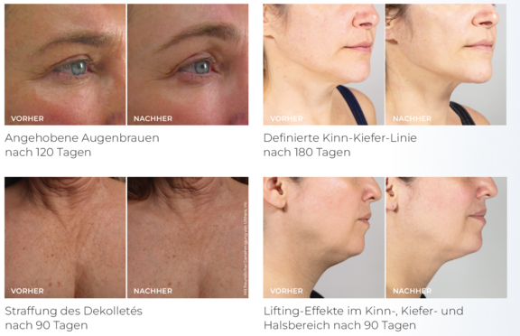 Vorher- Nachher Ultherapy, prevention-center für Faltenunterspritzung und ästhetische Medizin in Bern