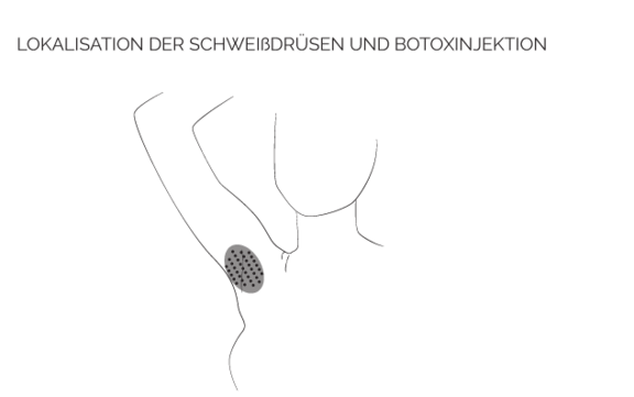 Hyperhidrose-Behandlung, prevention-center für Faltenunterspritzung und ästhetische Medizin in Bern